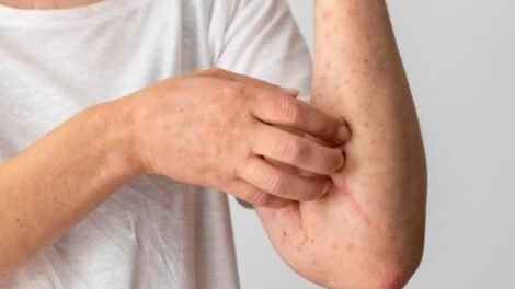ceara-investiga-quatro-casos-suspeitos-de-mpox-e-mantem-vigilancia-ativa-em-2026